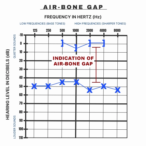 An example of how to identify an Air-Bone gap on an audiogram.